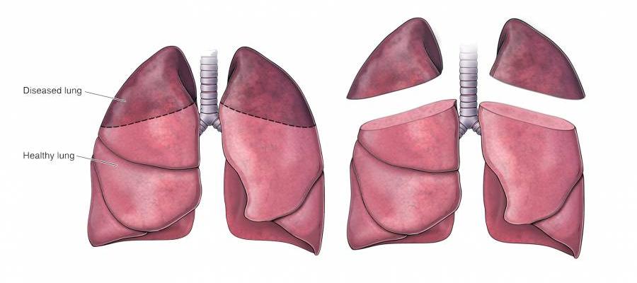 Graphic of diseased lung versus healthy lung to show which parts are removed during a lung volume reduction surgery