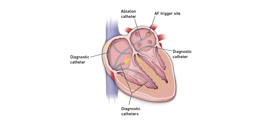 Cardiac ablation graphic