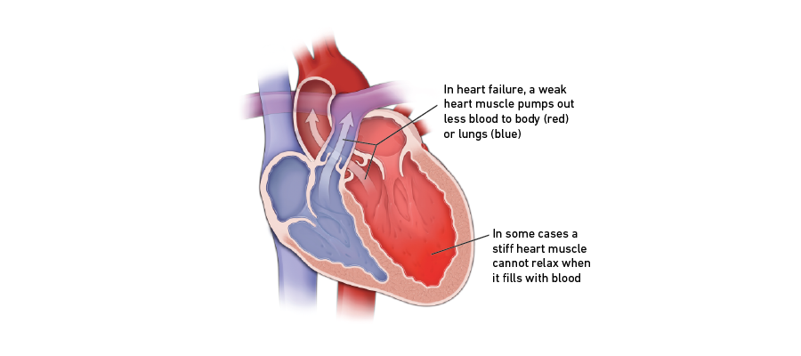 Heart failure graphic