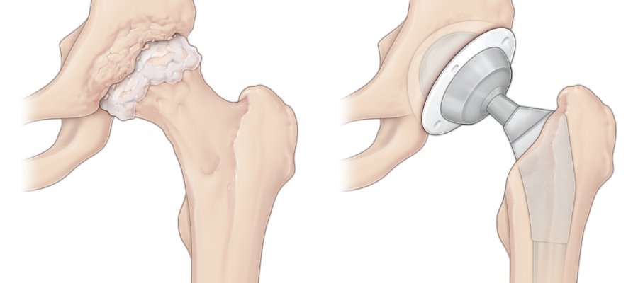 Hip replacement before and after graphic