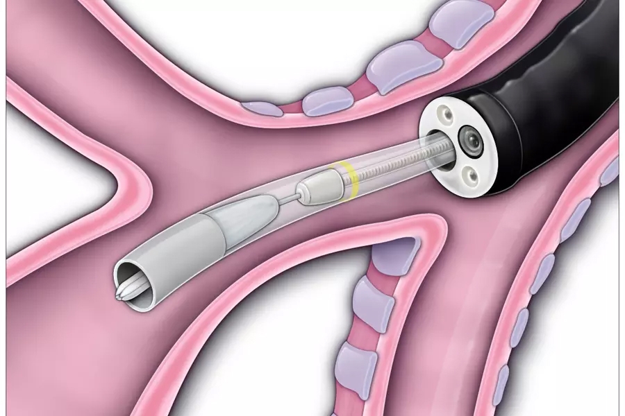 Illustration of an endobronchial valve being implanted in the lung via a special tool called a bronchoscope.
