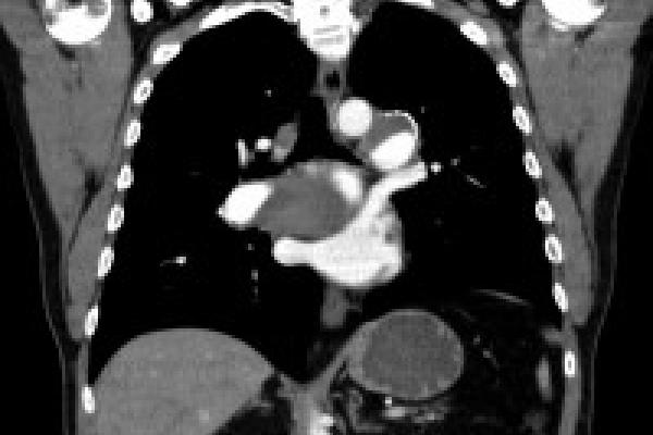 Temple patient's PTE CT scan