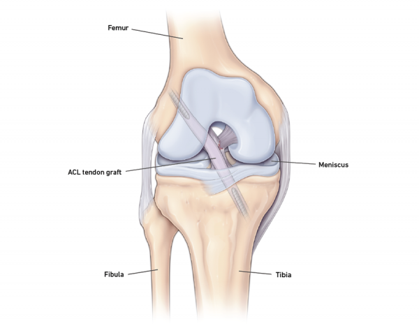ACL reconstruction and repair illustration