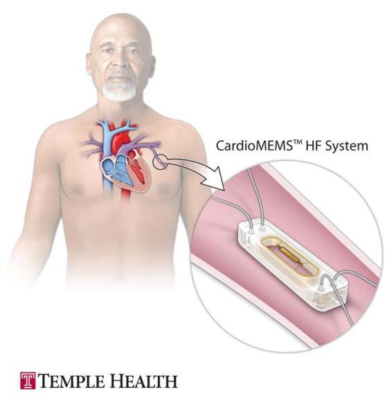 Illustration of the CardioMEMS Heart Failure System