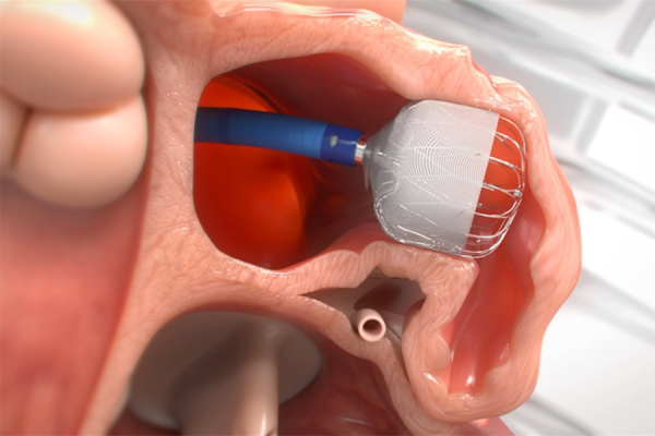Watchman Device procedure