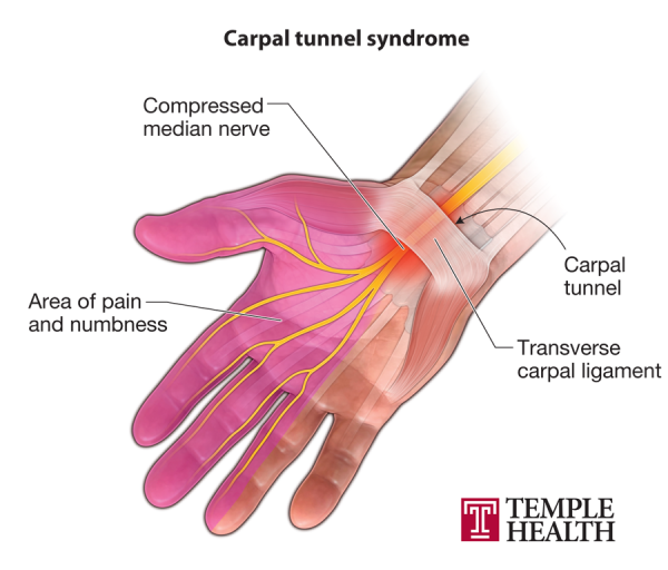Carpal tunnel diagram