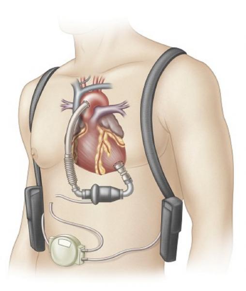 Ventricular Assist Device graphic