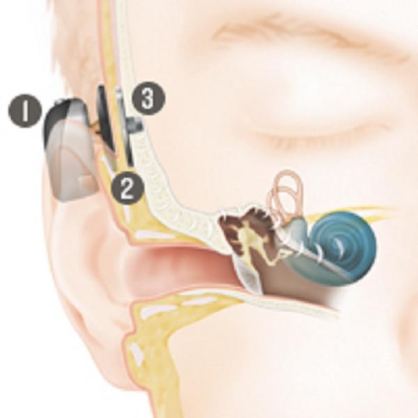 Bone anchored hearing system