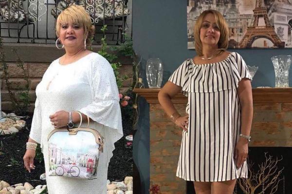 Bariatric patient before and after surgery