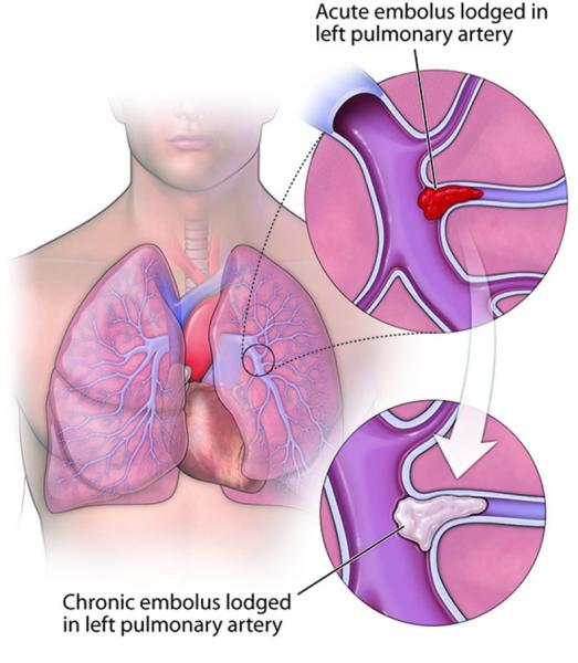 Graphic of chronic pulmonary embolism in left pulmonary artery