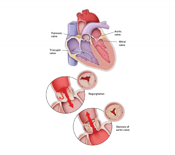 Heart valve conditions graphic